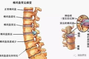 腰间盘脱出和突出有何区别 如何进行自我锻炼 