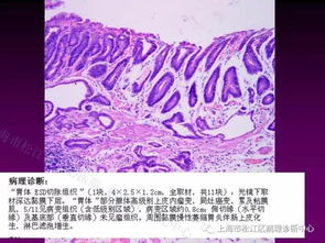 上消化道低级别上皮内瘤变的那些事