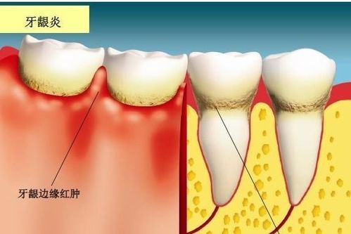 为什么牙龈炎不建议吃药