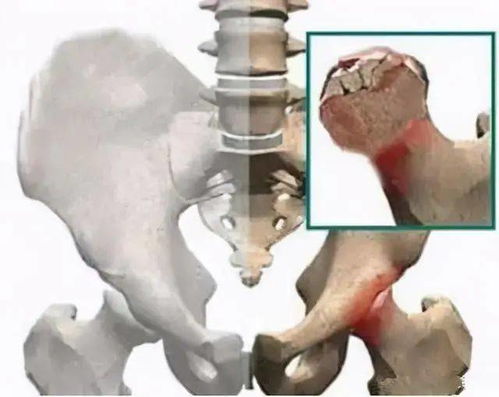 股骨头坏死分为哪些类型 都有什么表现