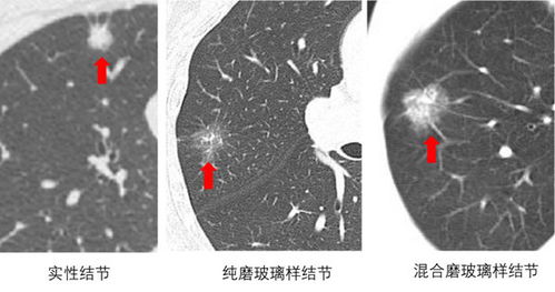 体检查出肺结节,要不要手术切除 医生教一招辨别良恶性