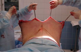 胆小慎入 恐怖的整形吸脂手术实拍全程 