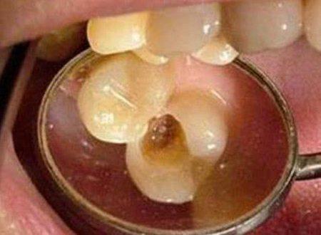吃糖牙就疼,人的牙齿里为啥会有虫子 是虫子喜欢吃糖果吗