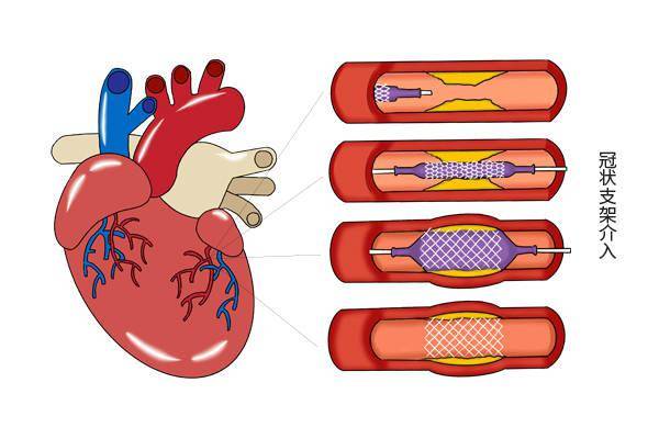 心脏搭桥和心脏支架一样吗 冠心病患者选择哪个好 听听医生分析