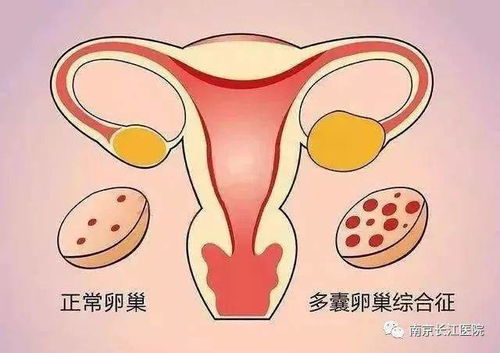 多囊卵巢卵泡？多囊卵巢一般多少个卵泡