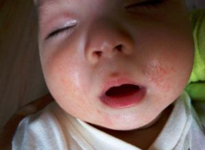 宝宝嘴角湿疹怎么起的 要想减轻需要做到这几点