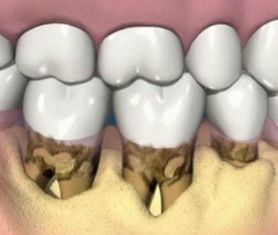 嘴巴有这些症状可能发展成牙结石,早发现早瓦解,不用洗牙不花钱