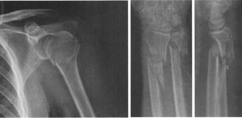 四肢骨折的分型丨上肢骨折及脱位