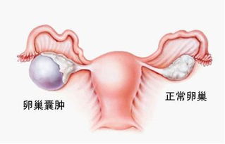 胆大心细、技术精湛，微创切除发生严重感染的卵巢囊肿！