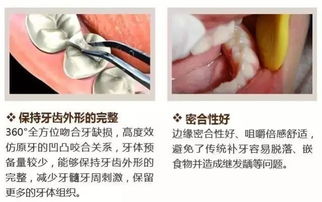 嵌体修复让你补牙不再担忧