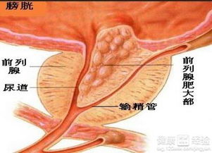 该怎样医治前列腺肥大