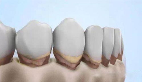 牙龈萎缩不分年龄 预防牙龈萎缩势在必行 别让青春毁于牙齿 