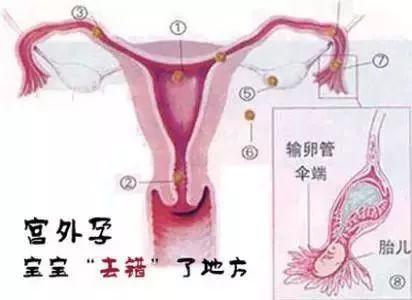 宫外孕流产后注意什么,宫外孕流产后需要注意哪些问题呢?