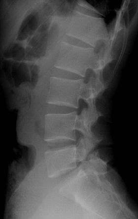 腰5椎弓峡部裂一定要做手术吗(腰5椎弓峡部裂开)