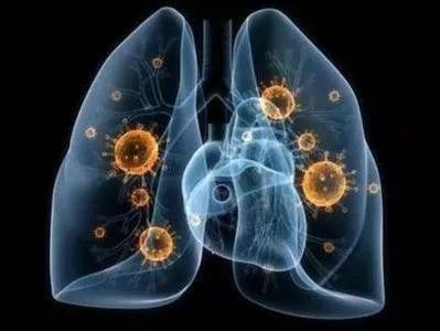 新型肺炎最开始的征兆，新冠肺炎的早期征兆有哪些