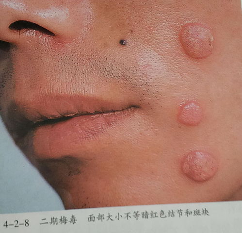 高危行为后,勿把梅毒当皮肤病 这些皮肤表现,或是身体在求救