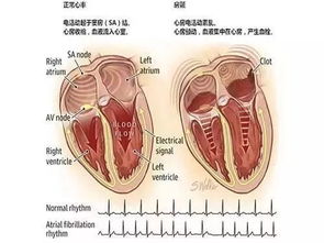 治心衰，得先把房颤控制好(心衰加房颤病人能活多久)