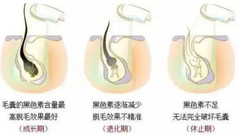 激光脱毛一直有效吗 肤色和毛发会影响脱毛效果吗