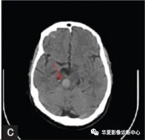 不同部位脑出血的表现