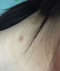 近期朋友说我脖子上有个疤一样的东西 我平常没任何感觉 一摸发现很粗糙 很想知道这是什么皮肤病吗 该 