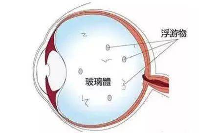 飞蚊症不管行不行