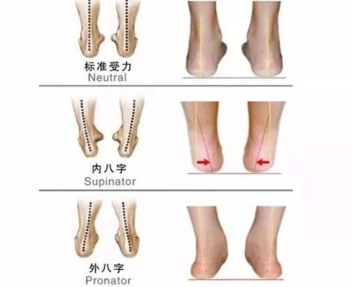 如何正确识别和矫正儿童 八字脚