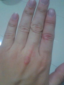 一个手指关节发红,红尘一个大点但是不痛不痒 