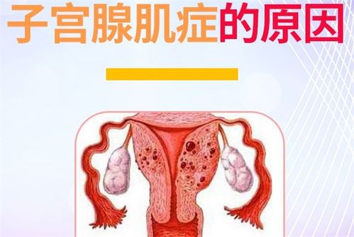 关于子宫腺肌症的一些常见知识