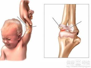 小孩的胳膊脱臼怎么办要去医院吗