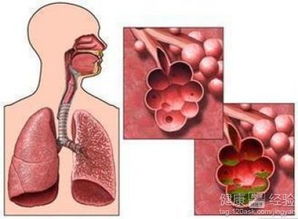 治疗肺气肿的特效方法