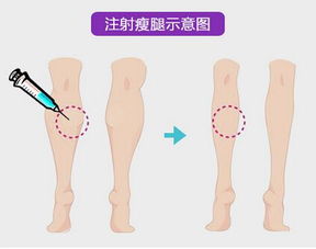 打瘦腿针真的会有效果吗