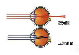 护眼时光 教你判断眼睛是否散光 