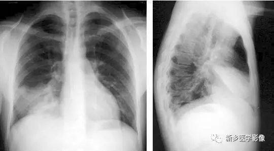 大叶性肺炎dr图片图片
