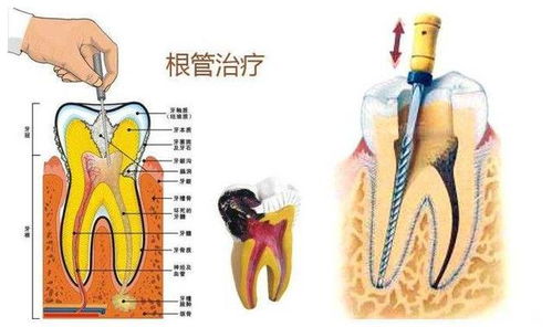 从补牙拖到根管治疗 你要多花多少钱 