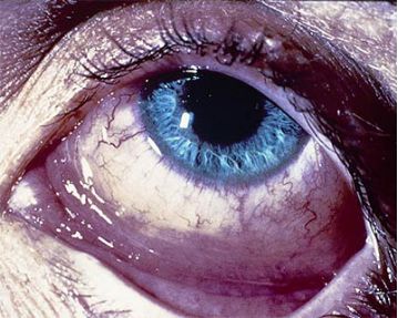 红眼病是怎么引起的,病毒性红眼病是怎么引起的