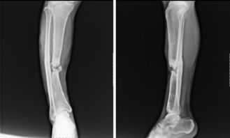 右胫骨骨不连并畸形愈合的治疗 请指教 米粒分享网 Mi6fx Com
