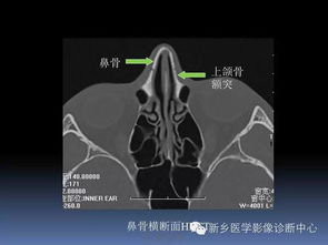 眉骨鼻骨复合骨折伤 图片搜索