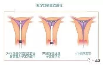 远离人流 谈谈如何避孕 