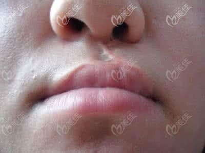 兔唇嘴上的疤痕怎么去掉 激光对唇裂手术疤痕有效吗