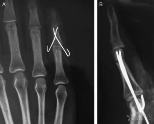 第四指骨骨折图片 图片欣赏中心 急不急图文 Jpjww Com