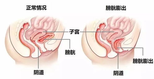 膨出 脱垂 尿失禁,产后受伤的盆底肌该如何快速恢复