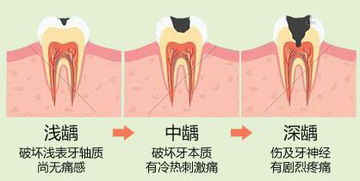 蛀牙可以自己抠干净吗