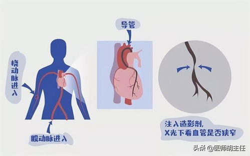 做完冠脉造影,病人就活不久了 冠脉造影检查对人体有什么危害