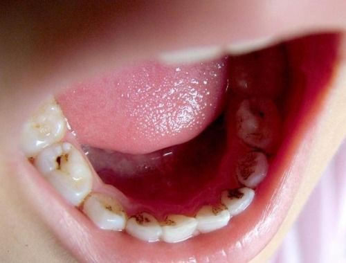 预防大于治疗 植得口腔儿牙医生建议,儿童龋齿早预防早治疗 