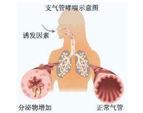 支气管哮喘(支气管哮喘的症状有什么)