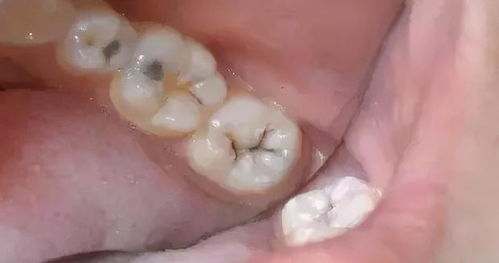 牙齿上有很多小黑点,不疼也不痒是怎么回事 告诉你背后的隐患