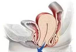不能说的秘密 女性盆底功能障碍