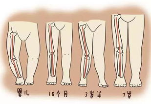 宝宝出现 O型腿 ,真的是因为没 绑腿 吗 