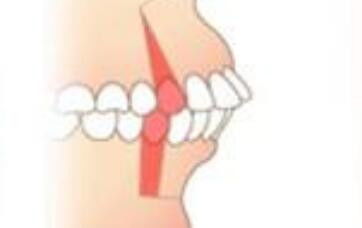 牙槽骨突出的原因 
