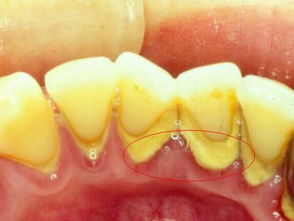 为什么要定期洗牙 洗牙对牙齿有伤害吗